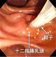 ERCP