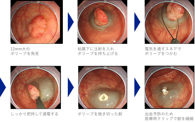 内視鏡的治療 | 池袋の消化器（胃腸）の専門病院 平塚胃腸病院