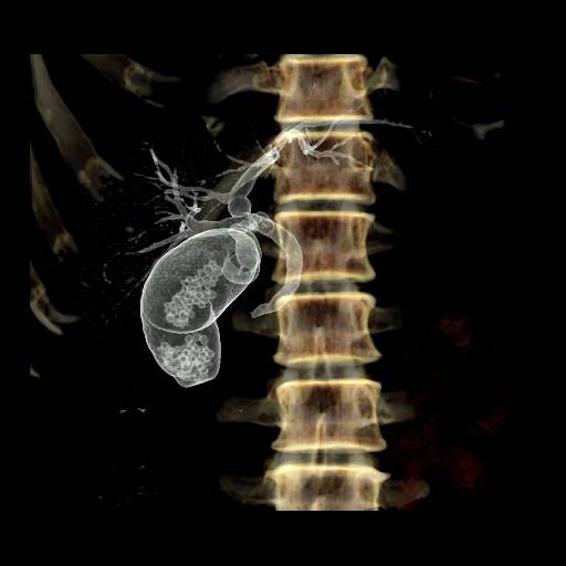 点滴静注胆嚢造影