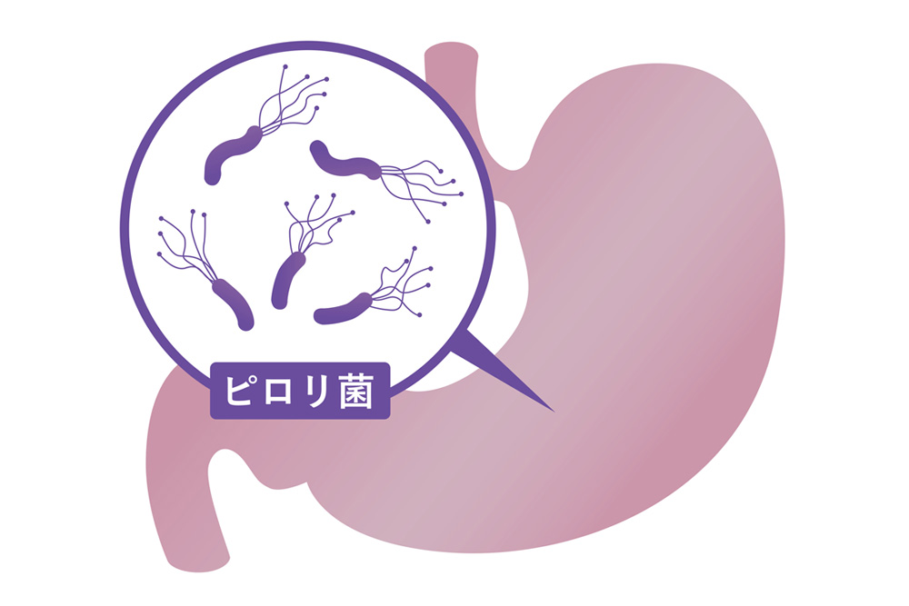 ホワイトボードに胃がんとはと書いているところ