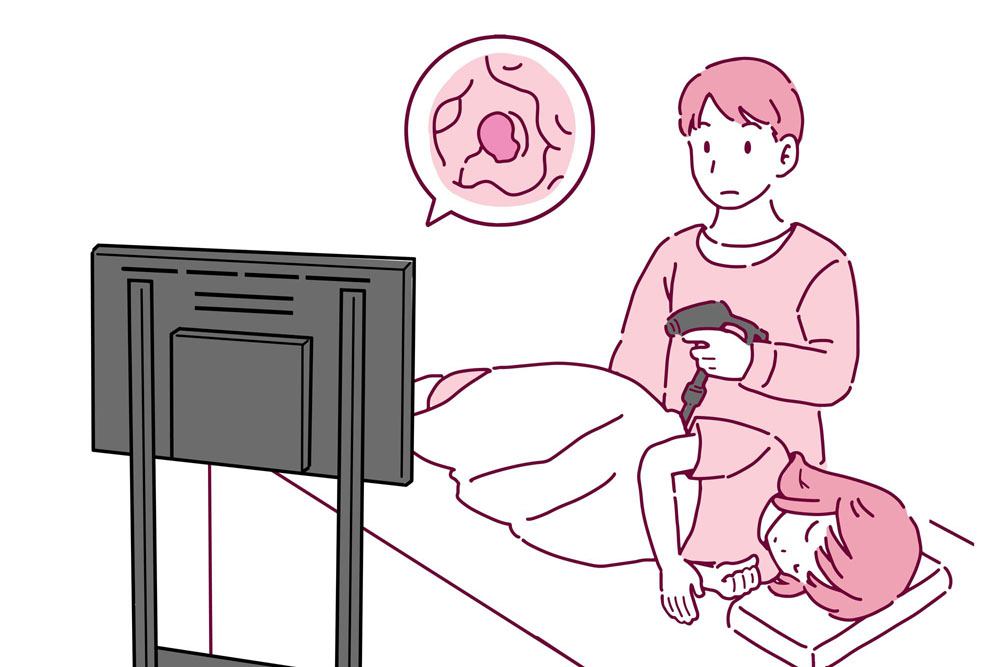 大腸内視鏡検査でポリープが見つかったところ