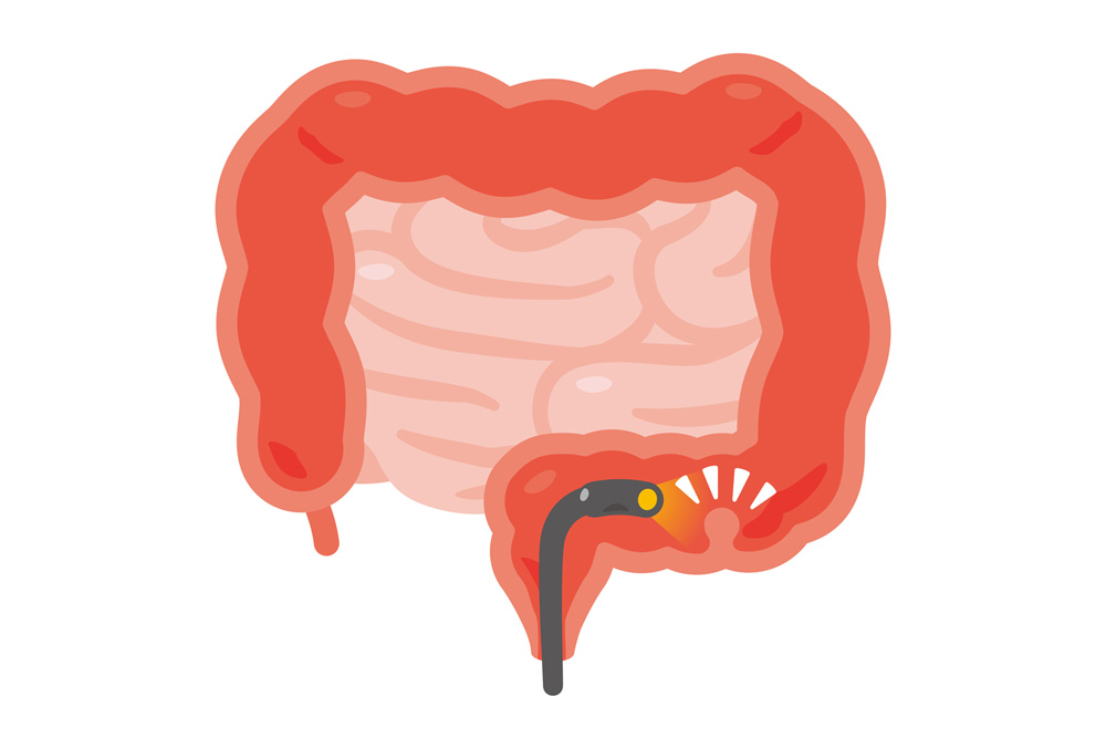 大腸カメラによって見つかった大腸ポリープのイメージ画像